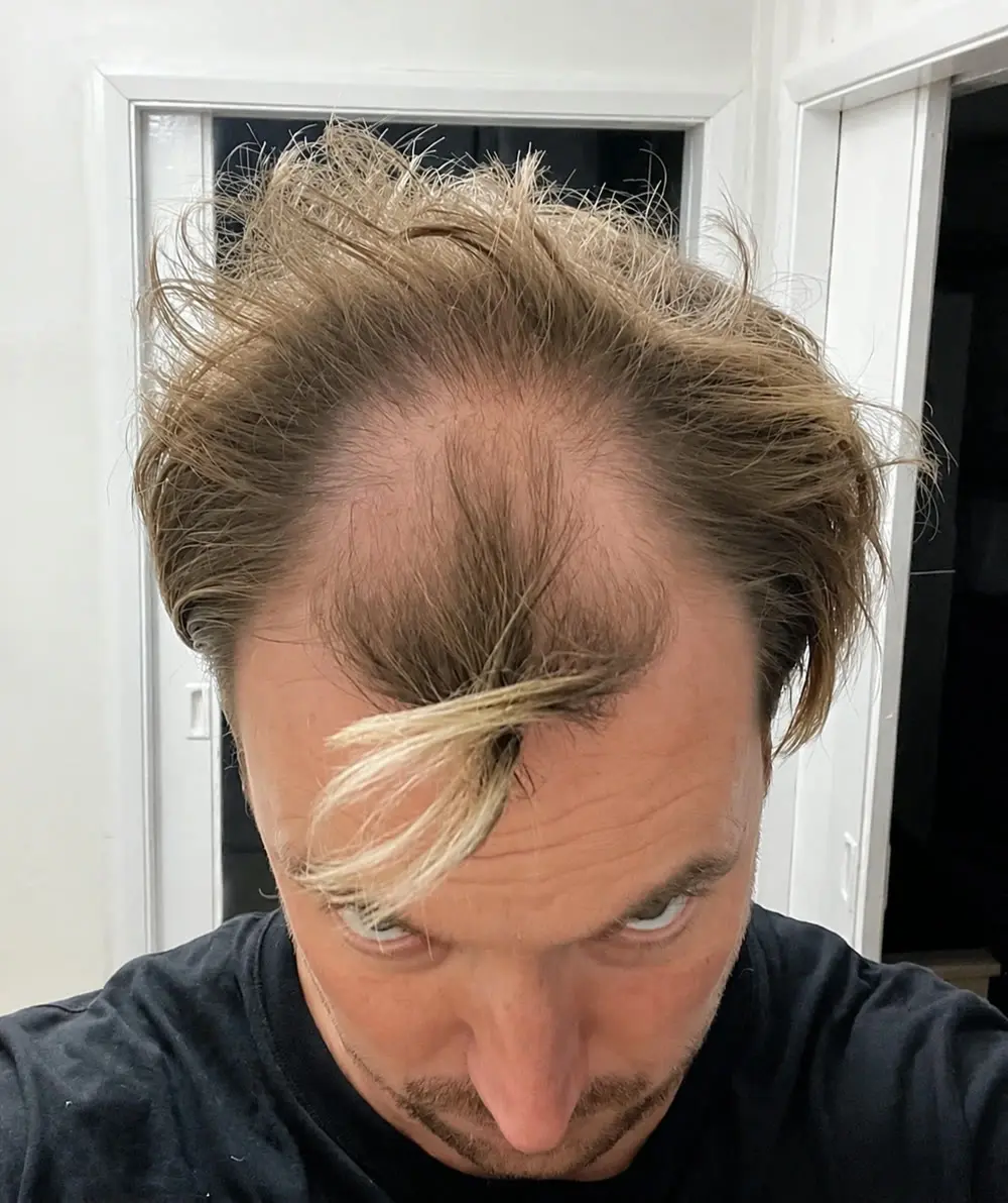 Steve before his hair transplant at Berkeley Hair Clinic