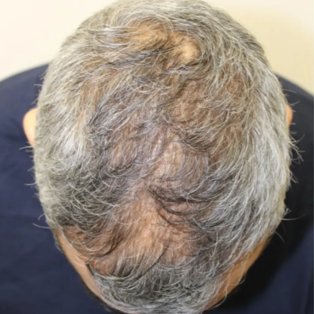 Frontal Hairline before