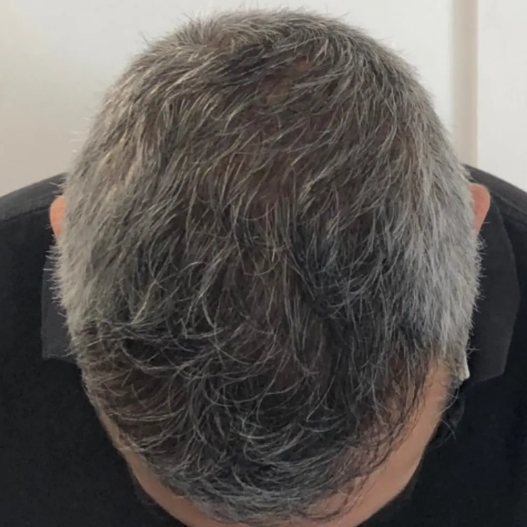 Frontal Hairline after