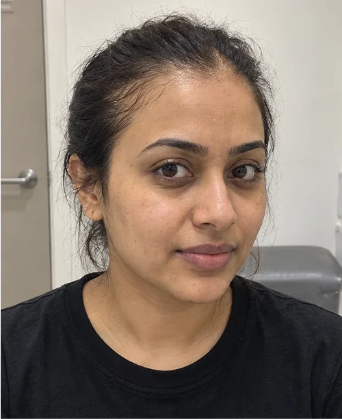 Amanda's Hair Transplant before