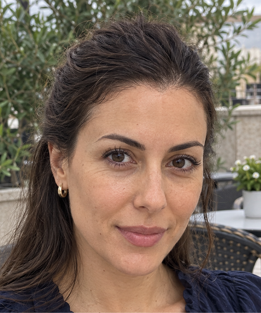 Elena's Hair Transplant after
