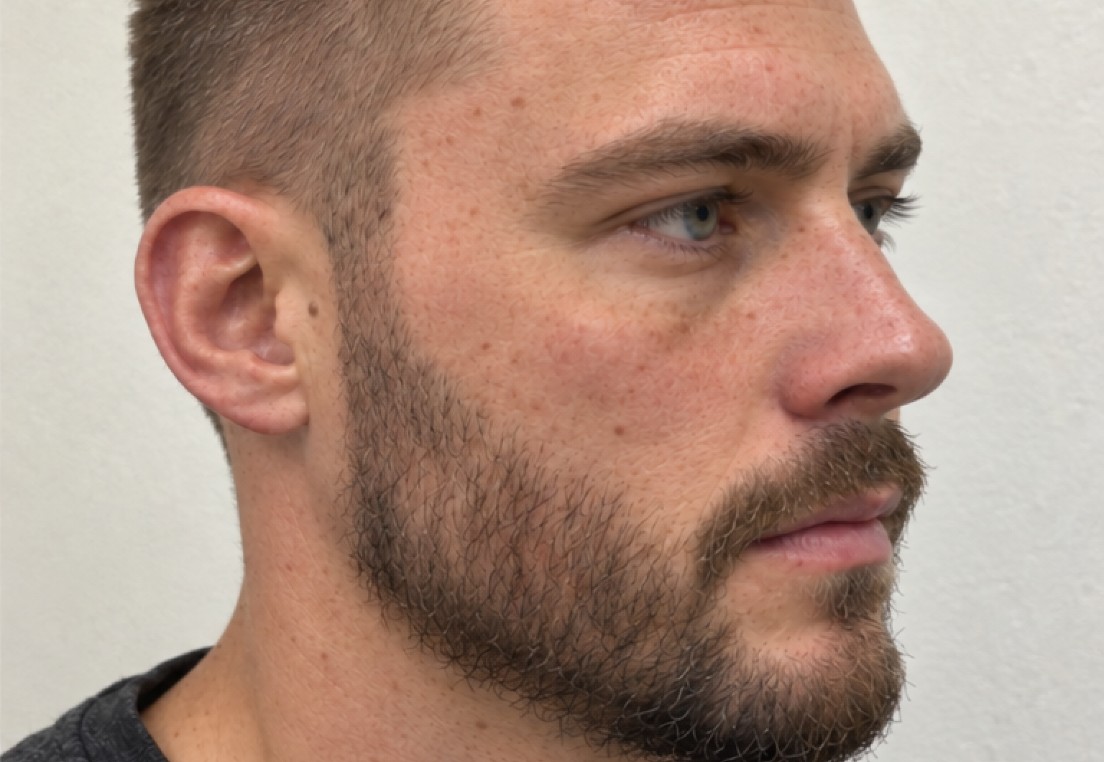 Daniel's Beard Transplant after