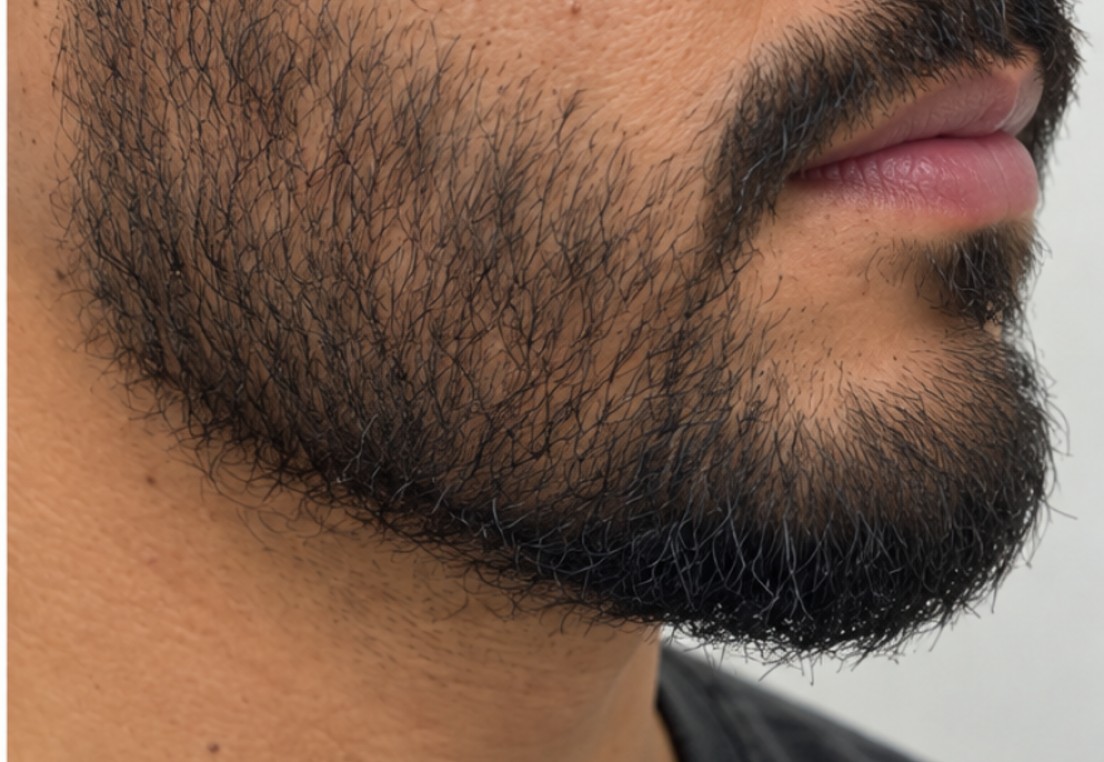 Ahmet's Beard Transplant after