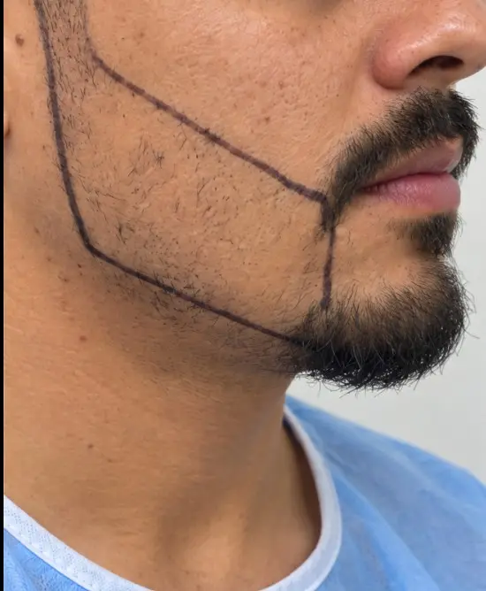 Ahmet's Beard Transplant before