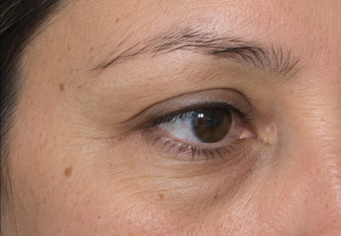 Jackie's Eyebrow Transplant before