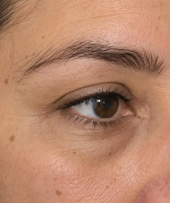 Jackie's Eyebrow Transplant after