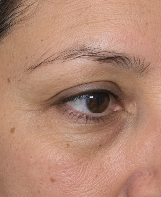 Jackie's Eyebrow Transplant before