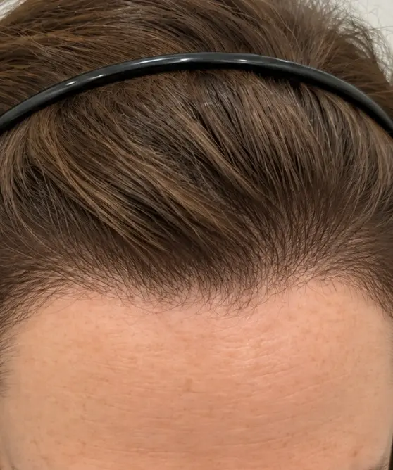Sarah's Hair Transplant after