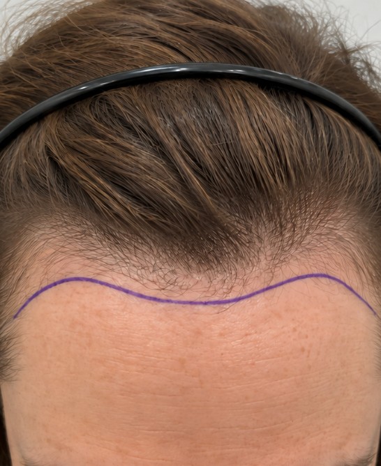 Sarah's Hair Transplant before