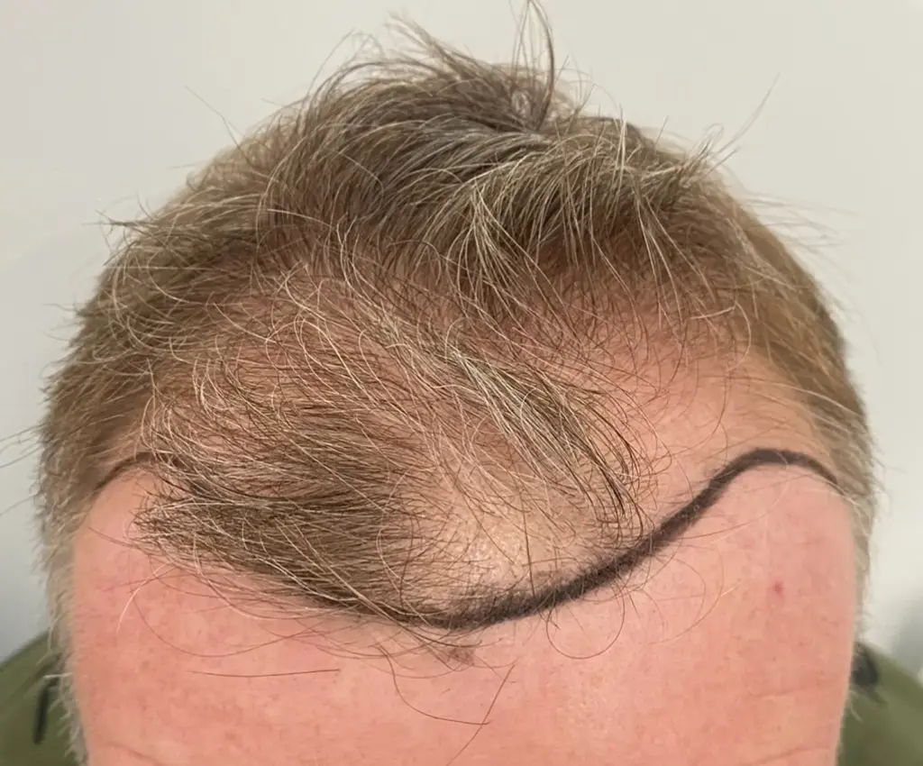 Frontal Hairline before