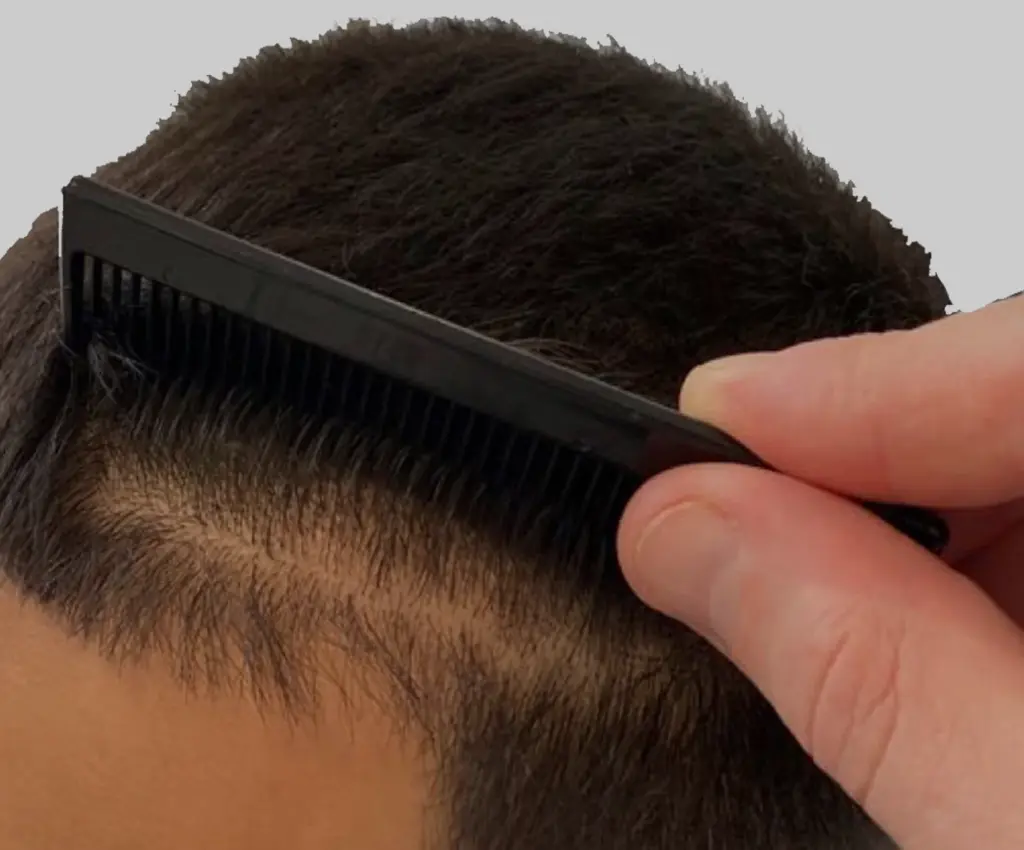 Frontal Hairline after