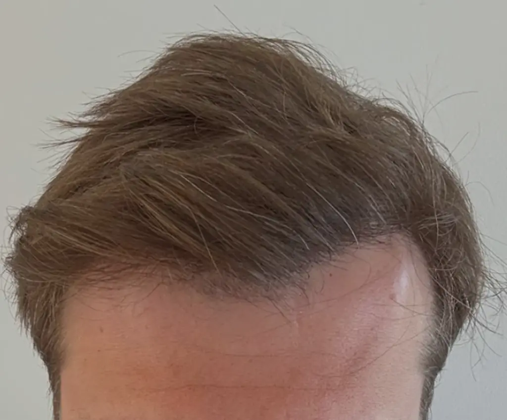 Full Scalp after