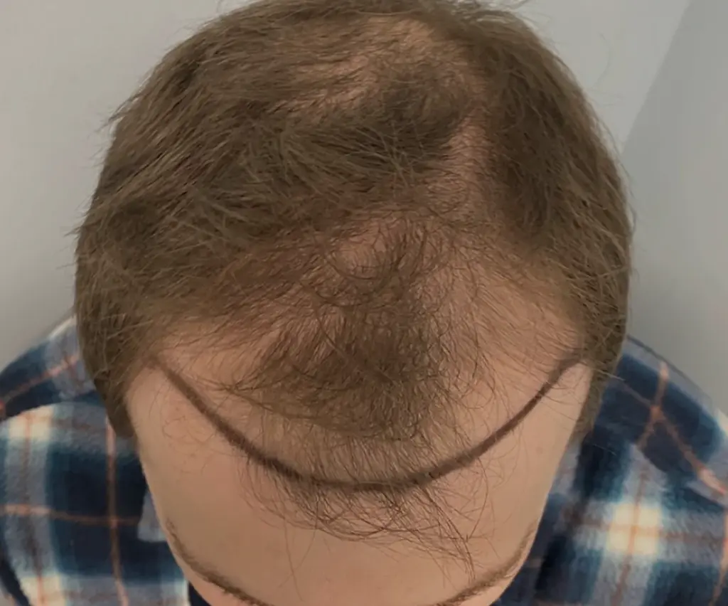 Full Scalp before
