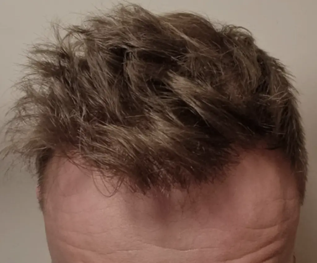 Frontal Hairline after