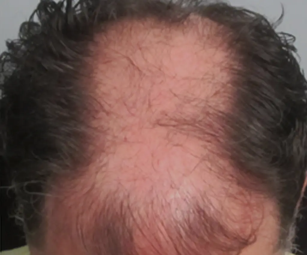 Full Scalp before