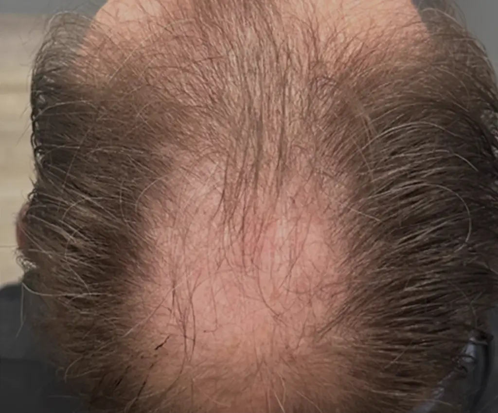 Full Scalp before