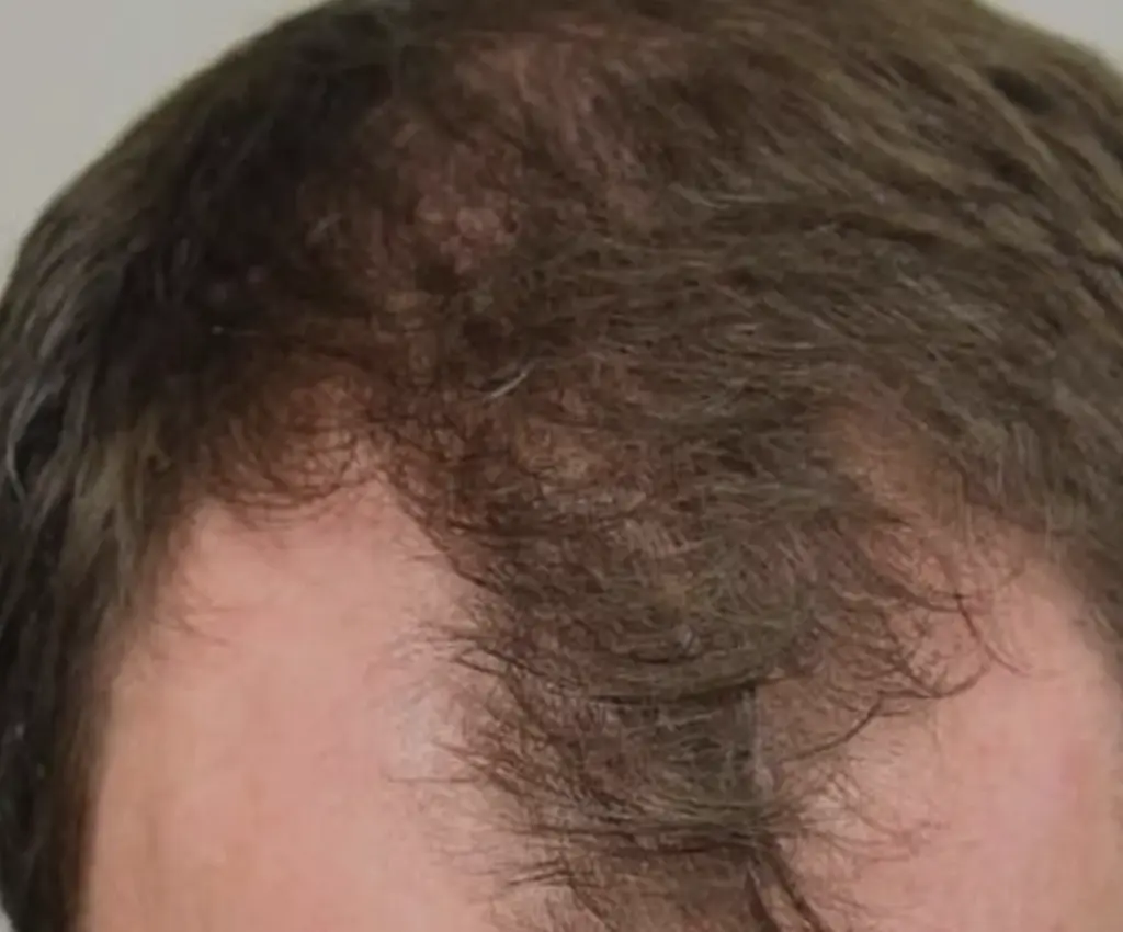 Frontal Hairline before
