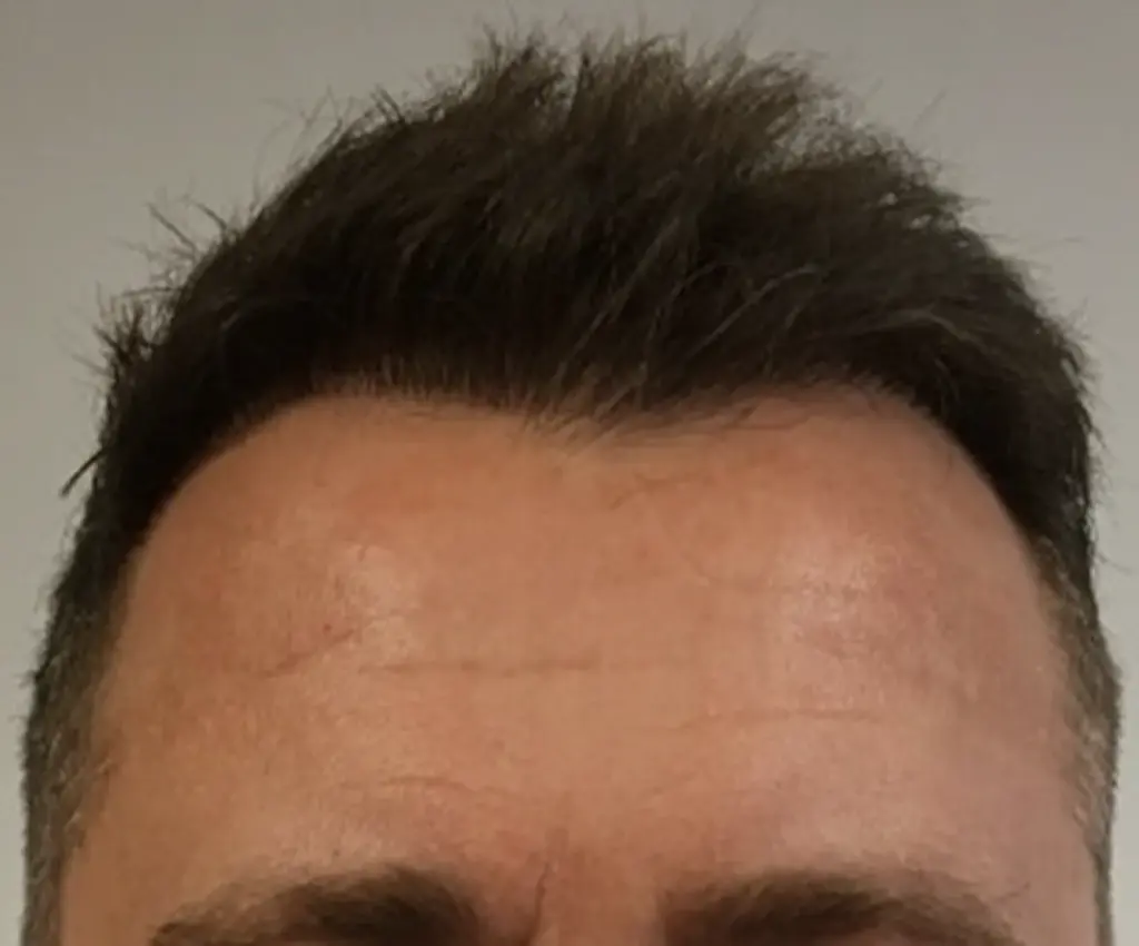 Frontal Hairline after