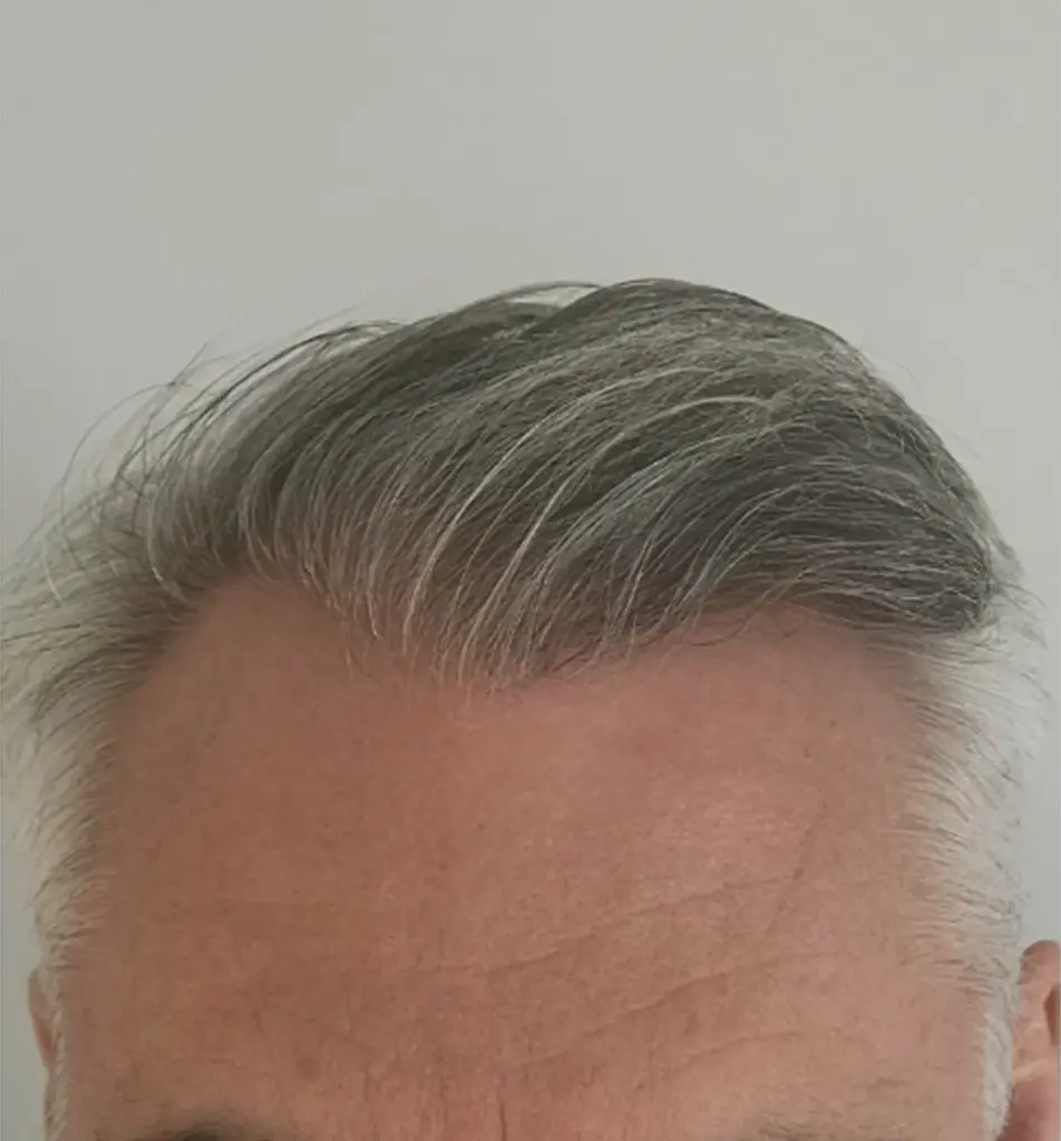 Full Scalp after