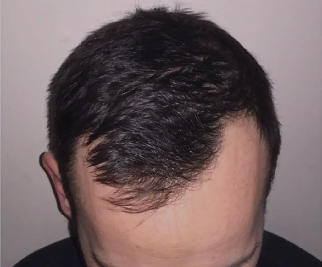 Full Scalp before