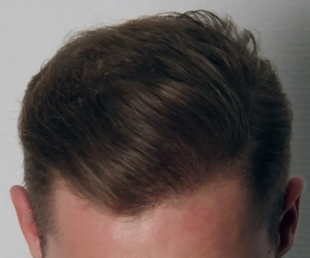 Full Scalp after