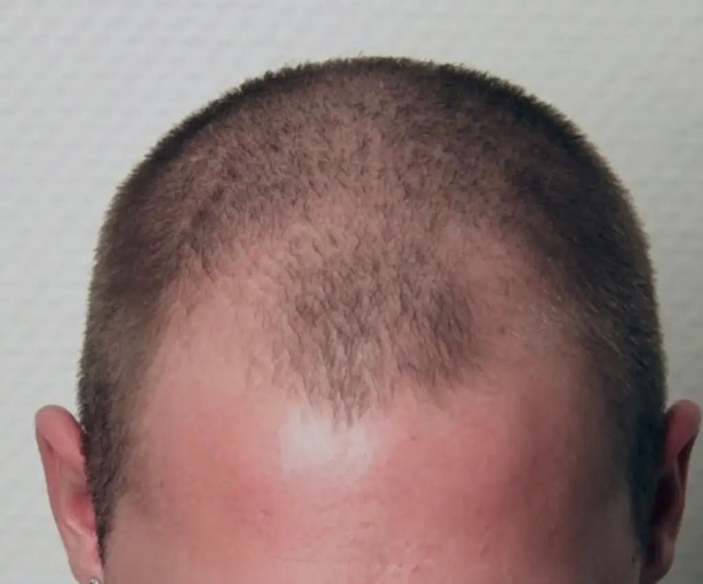 Full Scalp before