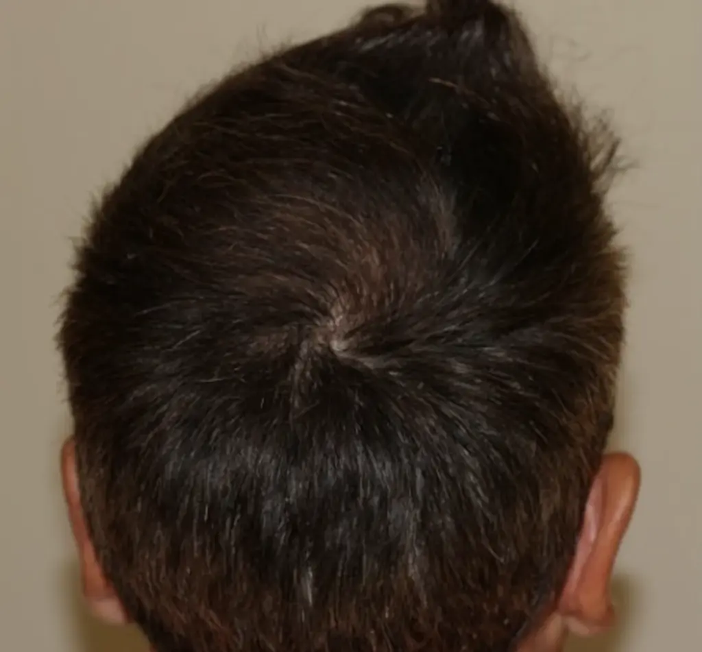 Crown after