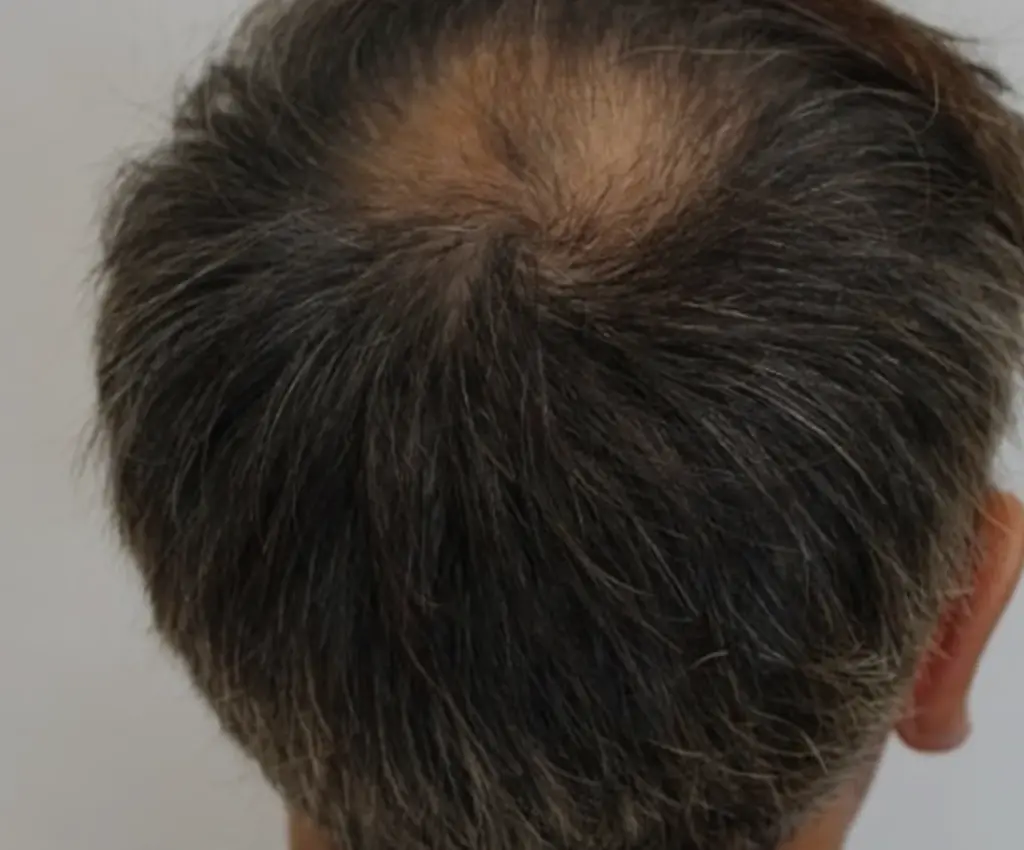 Crown before