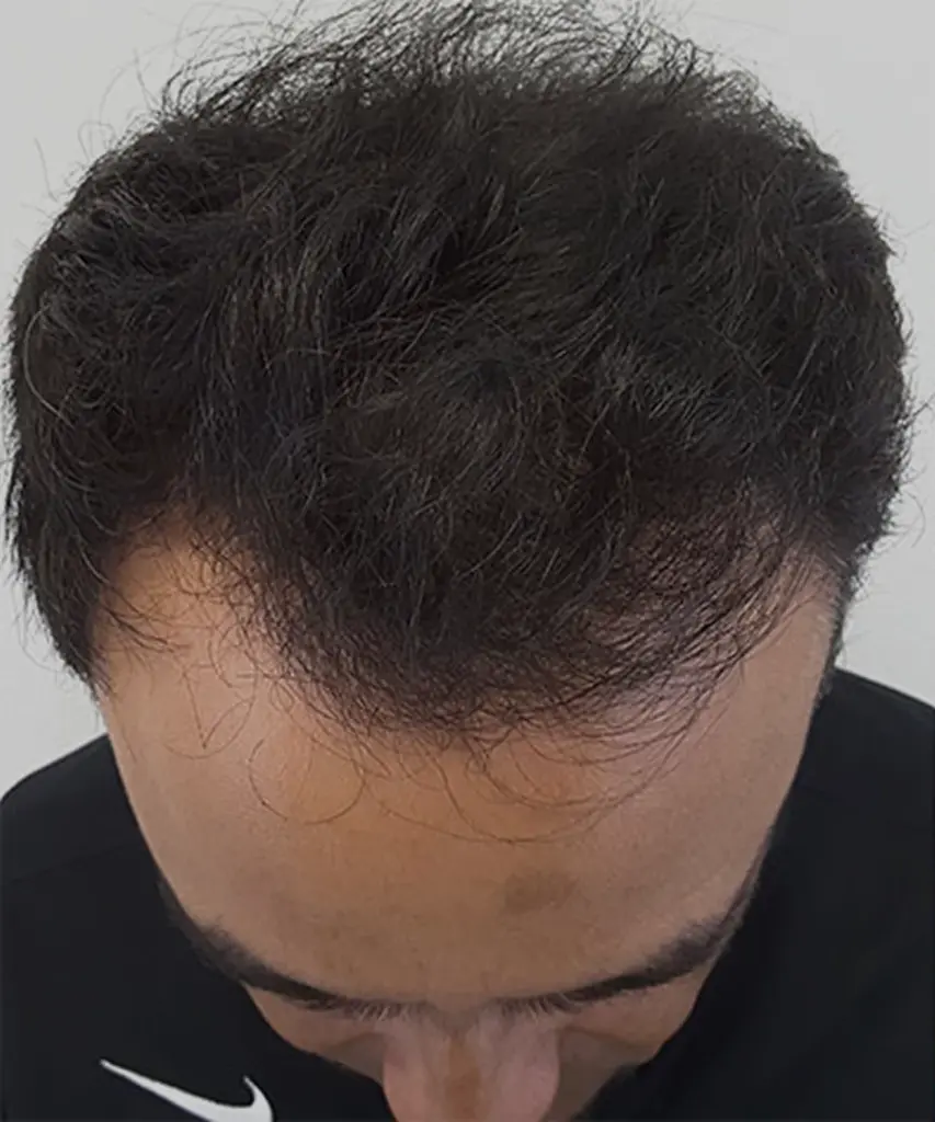 Full Scalp after