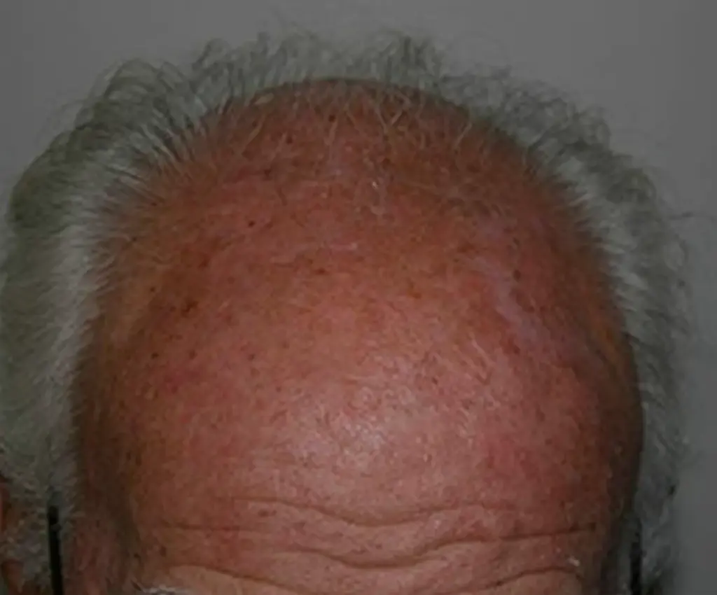 Full Scalp before