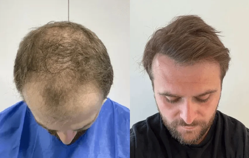 Harry before and after his FUE hair transplant