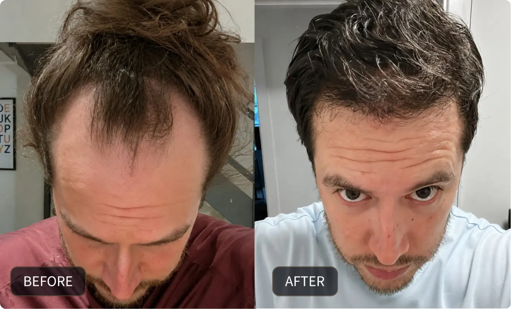 Adam before and after his FUE hair transplant
